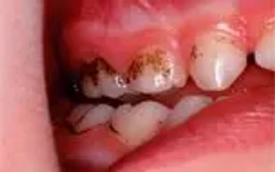 به این دلیل حتما سراغ مسواک و نخ دندان می‌روید
