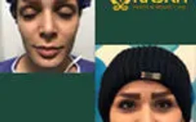 هزینه تزریق چربی به صورت در سال 1404 چقدر است؟