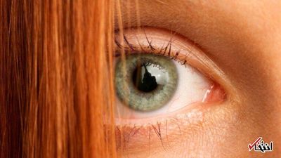 ژن موهای قرمز می‌تواند توضیح دهد چرا برخی زخم‌ها هرگز التیام نمی‌یابند
