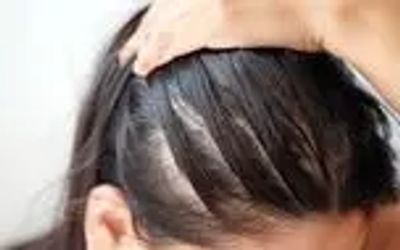 یک حقیقت هولناک؛ تنها کمی استرس کافی است تا ریزش مو آغاز شود