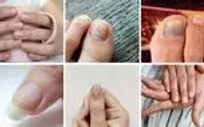 ۷ نشانه هشداردهنده کلسترول بالا که روی ناخن‌ها ظاهر می‌شوند
