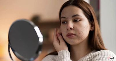آیا استرس مزمن با آکنه‌ی بزرگسالی مرتبط است؟