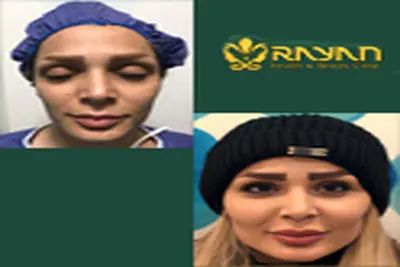 جدیدترین روش‌های تزریق چربی در سال 1404