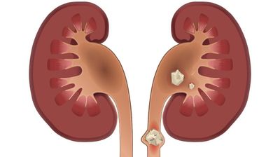 سنگ کلیه چه نشانه‌هایی دارد؟