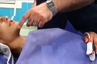 جراحی موفق فک برای دختر نوجوان سنندجی